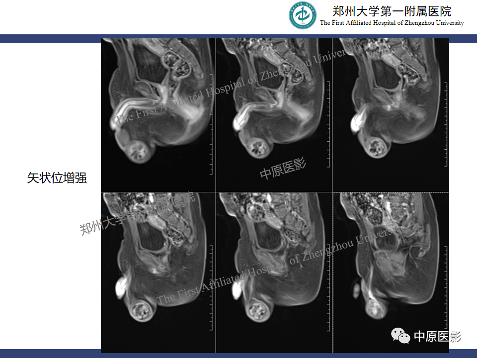 tfombr51kdd9543.png