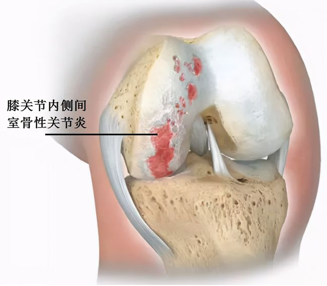 股骨髁关节软骨磨损.png