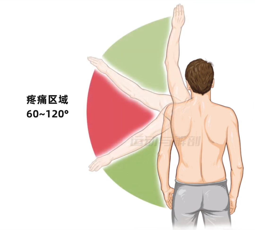 肩部评估干货——抬肩疼痛弧测试