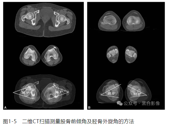 下肢生理力线及其临床意义